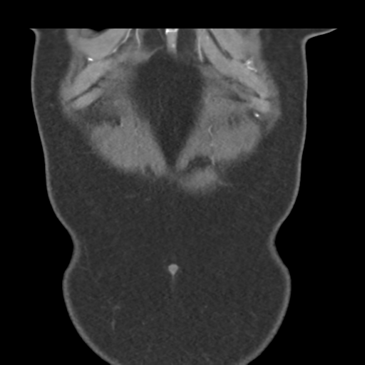 File:Normal CT renal artery angiogram (Radiopaedia 38727-40889 B 8).png