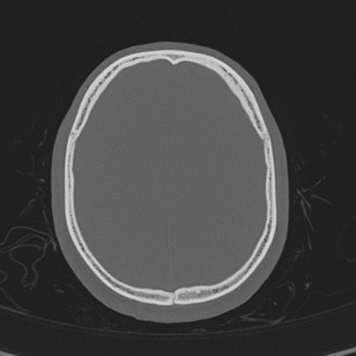 Normal CT skull (Radiopaedia 40798-43459 A 120).png