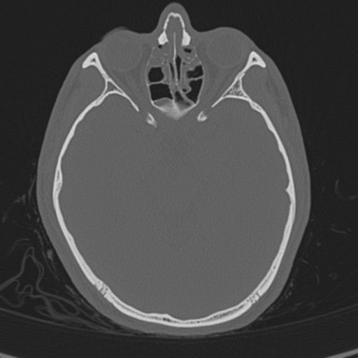 Normal CT skull (Radiopaedia 40798-43459 A 63).png