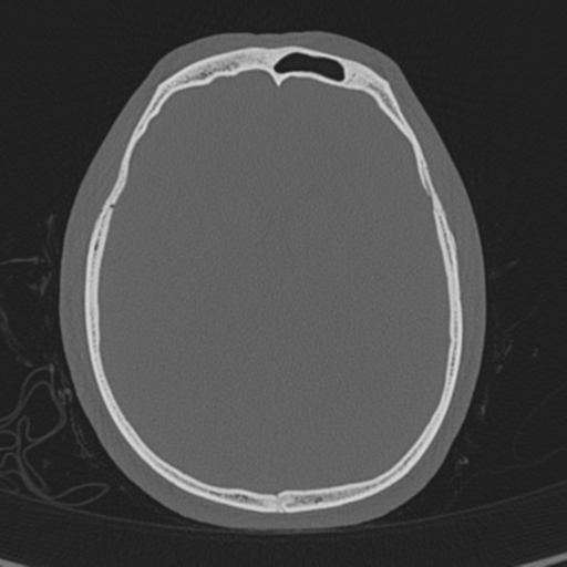 Normal CT skull (Radiopaedia 40798-43459 A 93).png
