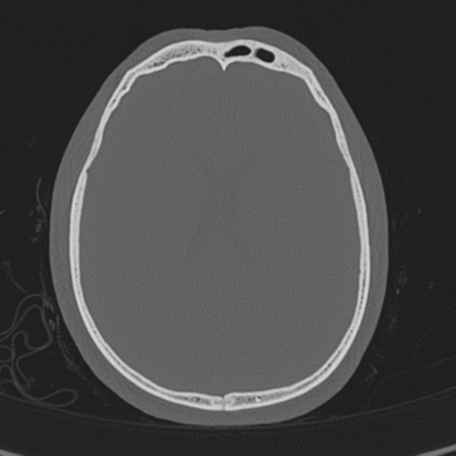 Normal CT skull (Radiopaedia 40798-43459 A 97).png