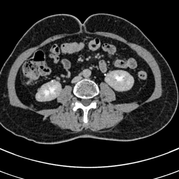 File:Normal CT split bolus study of the renal tract (Radiopaedia 48631-53634 Axial split bolus 138).jpg