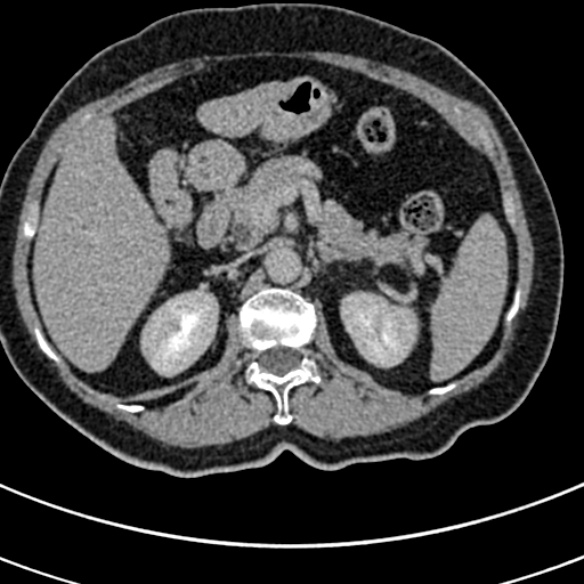 File:Normal CT split bolus study of the renal tract (Radiopaedia 48631-53634 Axial split bolus 41).jpg