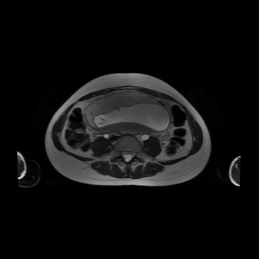 File:Normal MRI abdomen in pregnancy (Radiopaedia 88001-104541 Axial T2 42).jpg