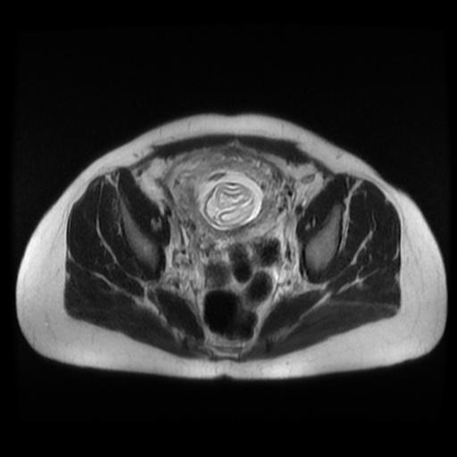 Normal MRI abdomen in pregnancy (Radiopaedia 88003-104546 Axial T2 40).jpg