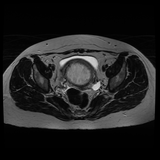 Normal MRI abdomen in pregnancy (Radiopaedia 88005-104548 Axial T2 30).jpg