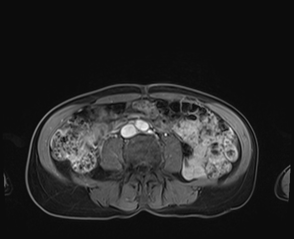 Normal adrenal glands MRI (Radiopaedia 82017-96004 K 64).jpg