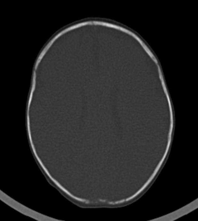 Normal brain CT - 2-month-old (Radiopaedia 53369-59350 Axial bone window 23).jpg