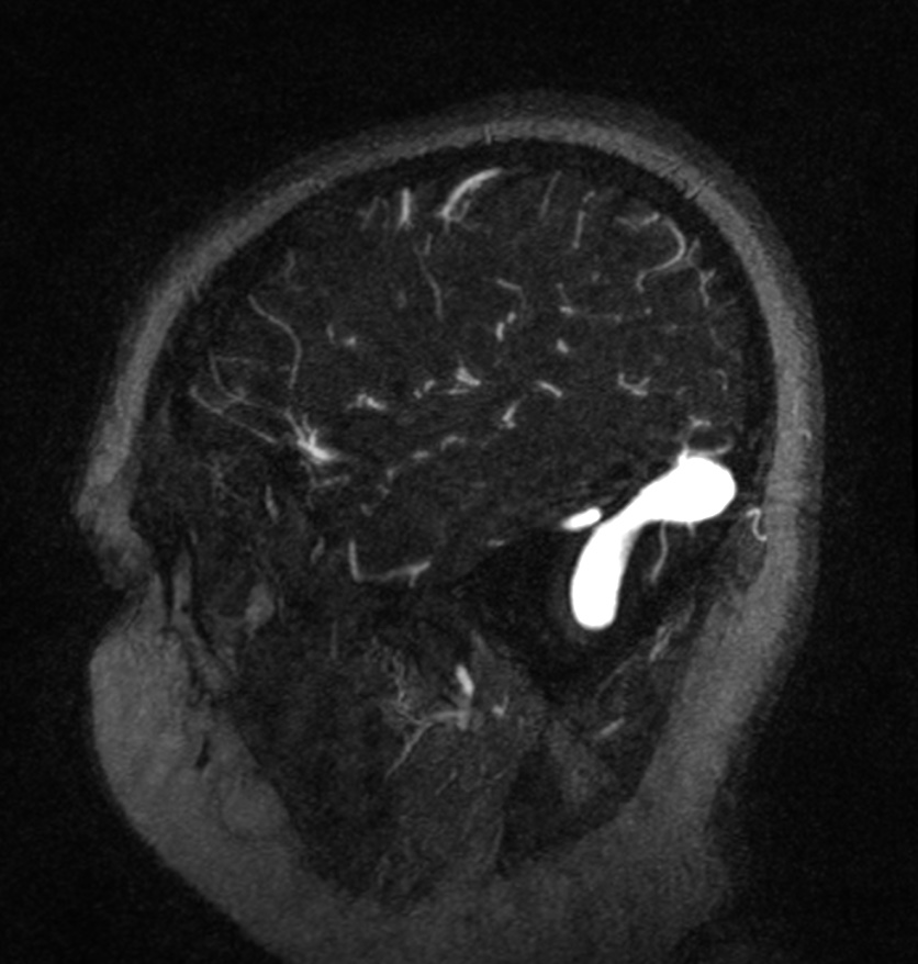 Normal brain MRI and venogram (Radiopaedia 39554-41862 Sagittal MRV 57).jpg