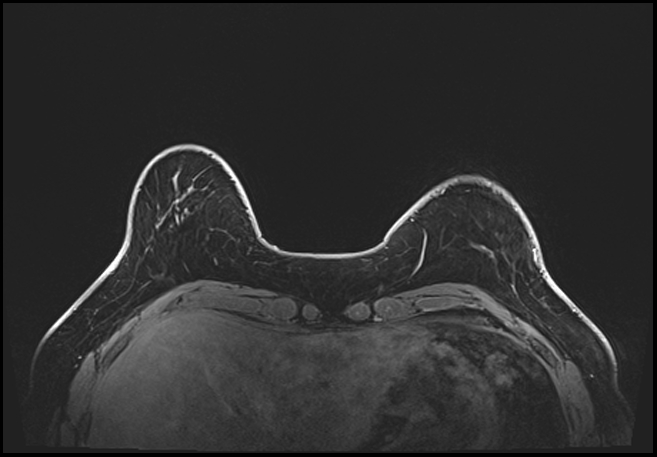 Normal breast MRI - dense breasts (Radiopaedia 80454-93850 C 42).jpg