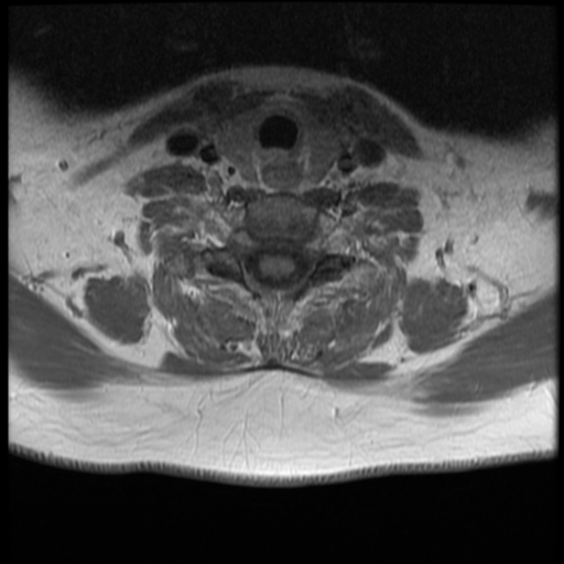 File:Normal cervical and thoracic spine MRI (Radiopaedia 35630-37156 Axial T1 C+ 10).png