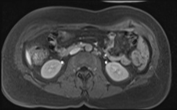 File:Normal hepatobiliary phase liver MRI (Radiopaedia 58968-66230 A 72).jpg