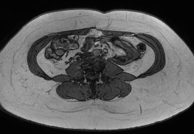 File:Normal liver MRI with Gadolinium (Radiopaedia 58913-66163 B 1).jpg