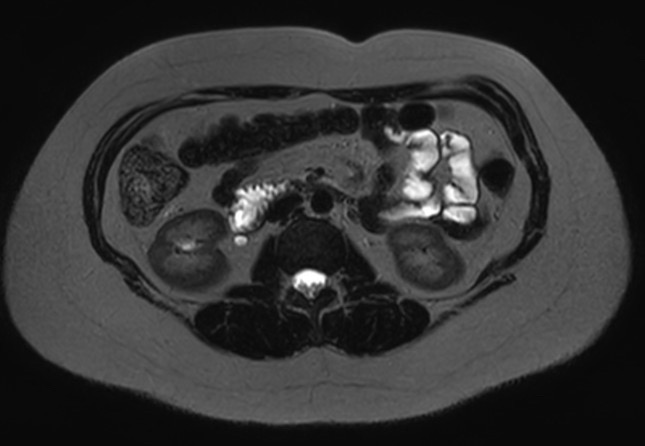 File:Normal liver MRI with Gadolinium (Radiopaedia 58913-66163 E 9).jpg