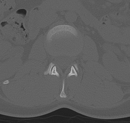 File:Normal lumbar spine CT (Radiopaedia 46533-50986 Axial bone window 18).png