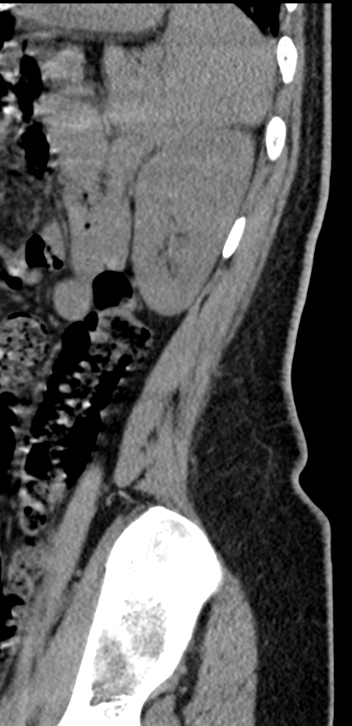 Normal lumbosacral CT (Radiopaedia 37923-39867 E 14).png