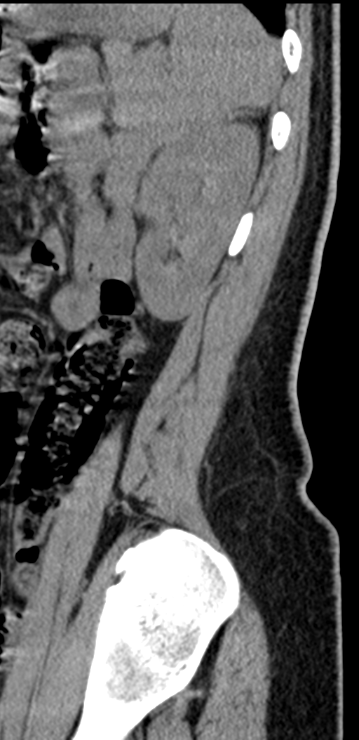Normal lumbosacral CT (Radiopaedia 37923-39867 E 17).png