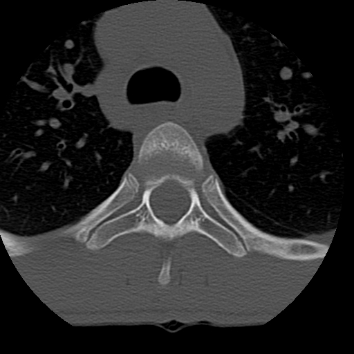 Normal trauma spine imaging (age 16) (Radiopaedia 45335-49358 Axial bone window 108).jpg