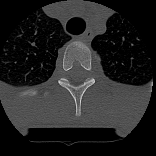 File:Normal trauma spine imaging (age 16) (Radiopaedia 45335-49358 Axial bone window 91).jpg