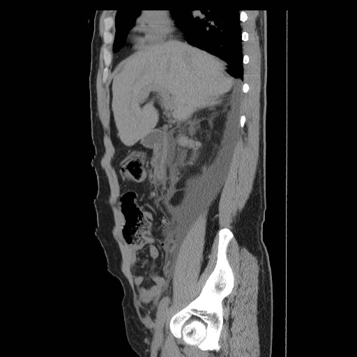 File:Obstructed kidney with perinephric urinoma (Radiopaedia 26889-27066 B 16).jpg