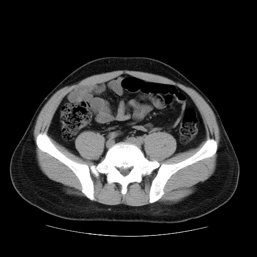 File:Obstructing ureteric calculus (Radiopaedia 18615-18514 Axial non-contrast 38).jpg