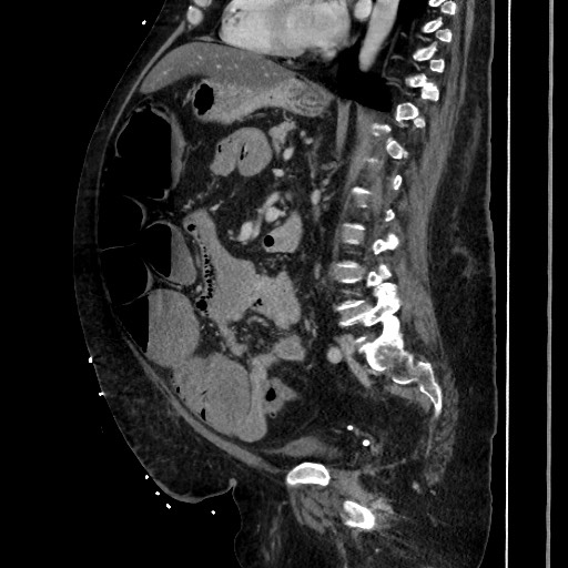 Obstructive colonic diverticular stricture (Radiopaedia 81085-94675 C 138).jpg