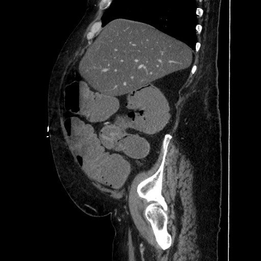 Obstructive colonic diverticular stricture (Radiopaedia 81085-94675 C 70).jpg