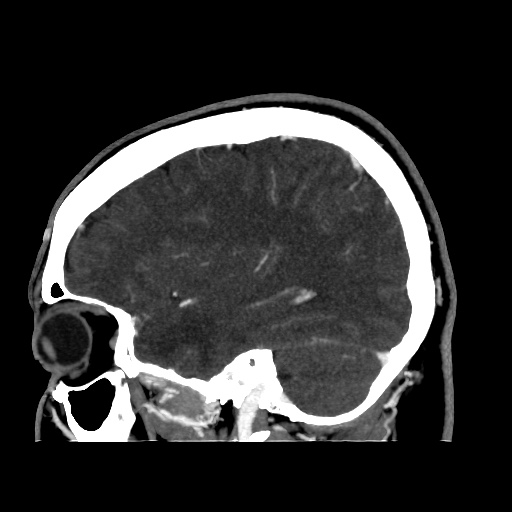 Occipital extradural hematoma simulating venous sinus thrombosis (Radiopaedia 46514-50964 D 56).jpg