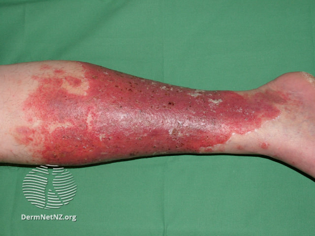 File:Topical medication allergy (DermNet NZ dermatitis-topical-medicine-allergy3).jpg