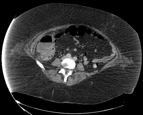 File:Abdominal abscess - pre and post percutaneous drainage (Radiopaedia 60209-67816 Axial 40).png
