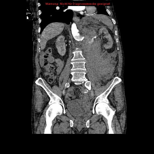File:Abdominal aortic aneurysm- extremely large, ruptured (Radiopaedia 19882-19921 Coronal C+ arterial phase 60).jpg
