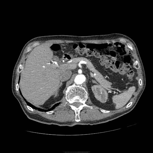 Abdominal aortic aneurysm (Radiopaedia 13341-13340 Axial C+ arterial phase 51).jpg