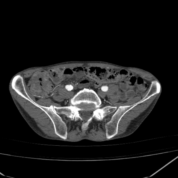 Abdominal aortic aneurysm (Radiopaedia 23703-23856 Axial C+ arterial phase 69).jpg