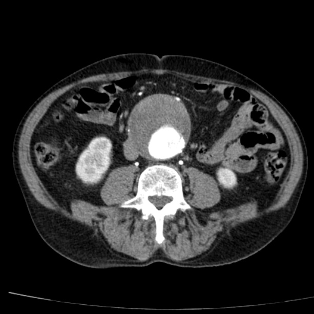 Abdominal aortic aneurysm (Radiopaedia 29248-29660 Axial C+ arterial phase 48).jpg