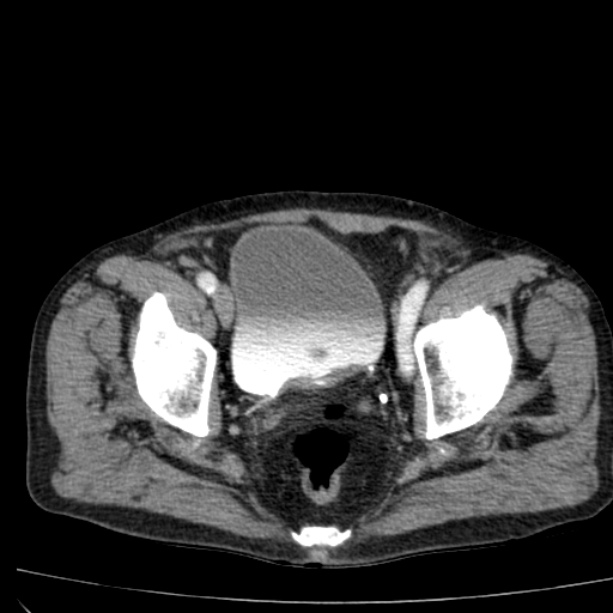 Abdominal aortic aneurysm (Radiopaedia 29248-29660 Axial C+ arterial phase 81).jpg