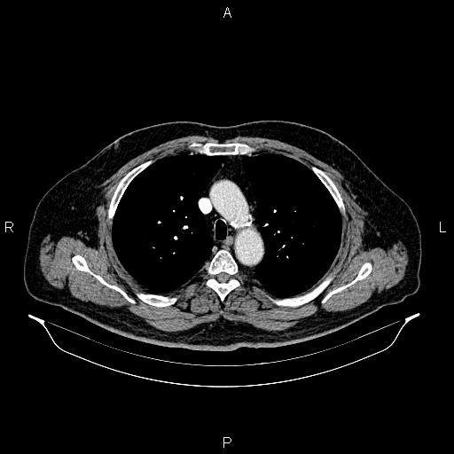 File:Abdominal aortic aneurysm (Radiopaedia 83094-97462 Axial renal cortical phase 26).jpg