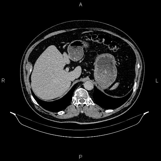 Abdominal aortic aneurysm (Radiopaedia 83094-97462 Axial renal excretory phase 29).jpg
