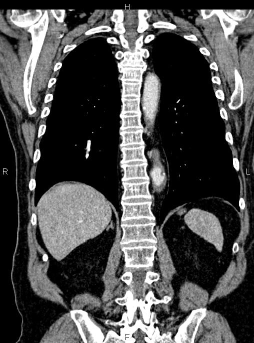 Abdominal aortic aneurysm (Radiopaedia 83094-97462 Coronal renal cortical phase 67).jpg