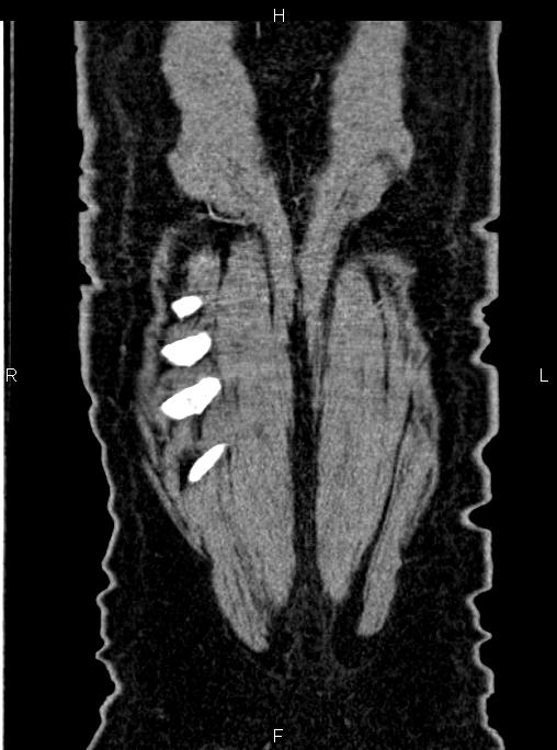 Abdominal aortic aneurysm (Radiopaedia 83094-97462 Coronal renal cortical phase 88).jpg