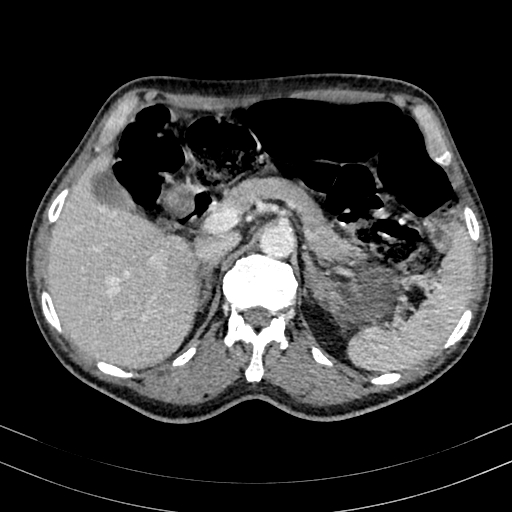 Abdominal aortic aneurysm (Radiopaedia 83581-98689 Axial C+ portal venous phase 32).jpg