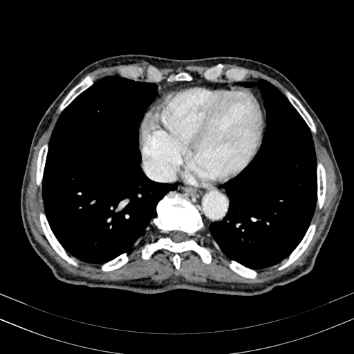 Abdominal aortic aneurysm (Radiopaedia 83581-98689 Axial C+ portal venous phase 6).jpg