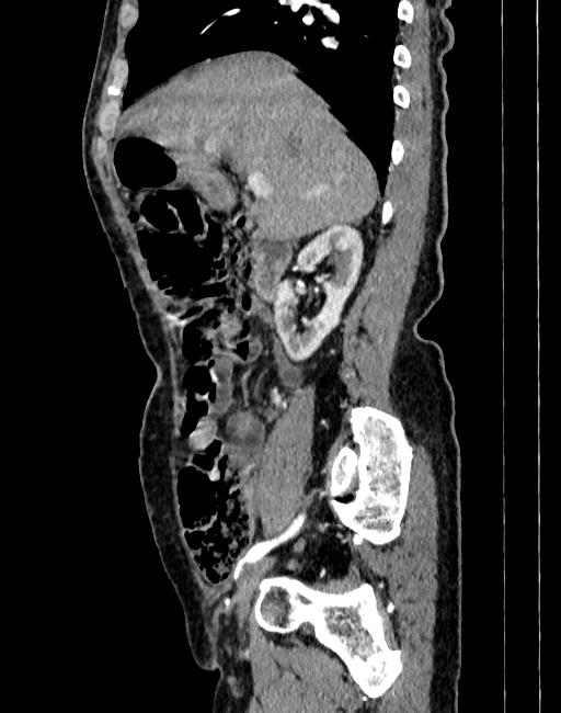 Abdominal aortic aneurysm (Radiopaedia 83581-98689 Sagittal C+ arterial phase 4).jpg