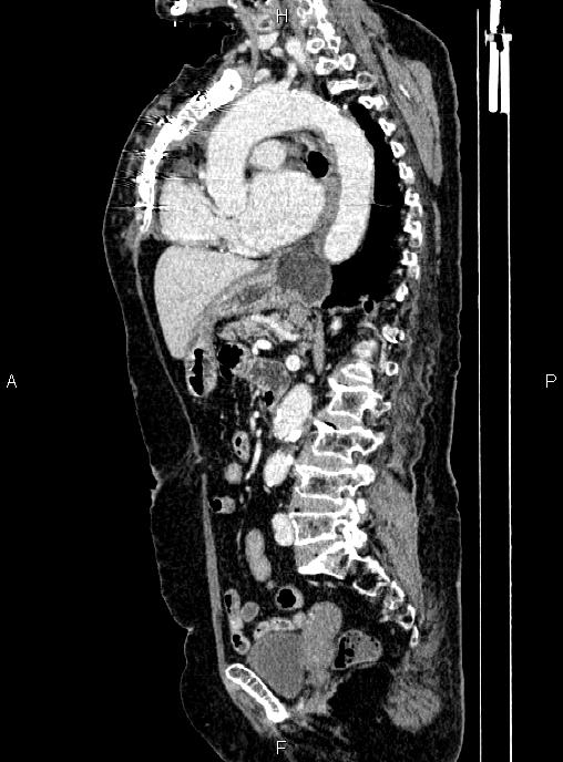Abdominal aortic aneurysm (Radiopaedia 85063-100606 Sagittal C+ arterial phase 46).jpg