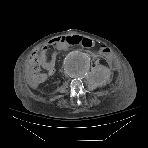 Abdominal aortic aneurysm - impending rupture (Radiopaedia 19233-19247 Axial non-contrast 97).jpg