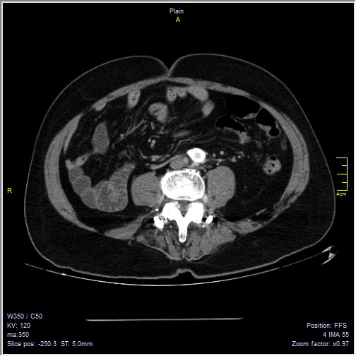 Abdominal aortic aneurysm with thrombus fissuration (Radiopaedia 47340-51926 Axial C+ arterial phase 39).jpg