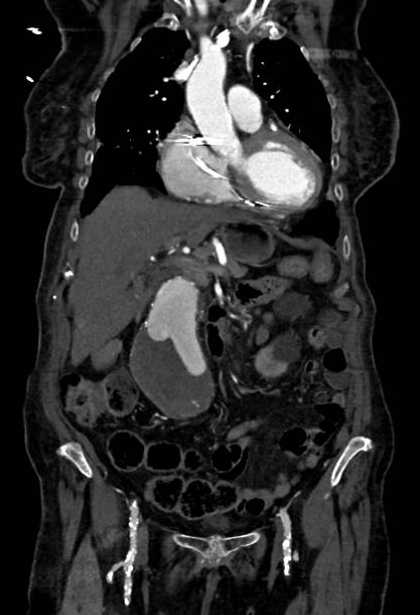 Abdominal aortic aneurysm with thrombus fissuration (Radiopaedia 73192-83919 Coronal C+ arterial phase 23).jpg