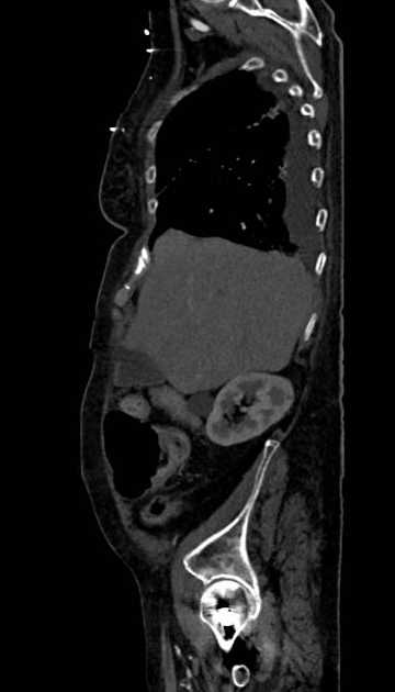 Abdominal aortic aneurysm with thrombus fissuration (Radiopaedia 73192-83919 Sagittal C+ arterial phase 115).jpg