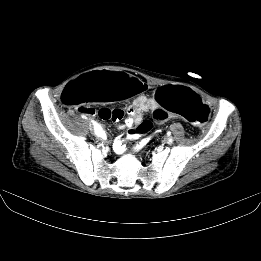 File:Abdominal collection due to previous cecal perforation (Radiopaedia 80831-94320 Axial C+ portal venous phase 162).jpg