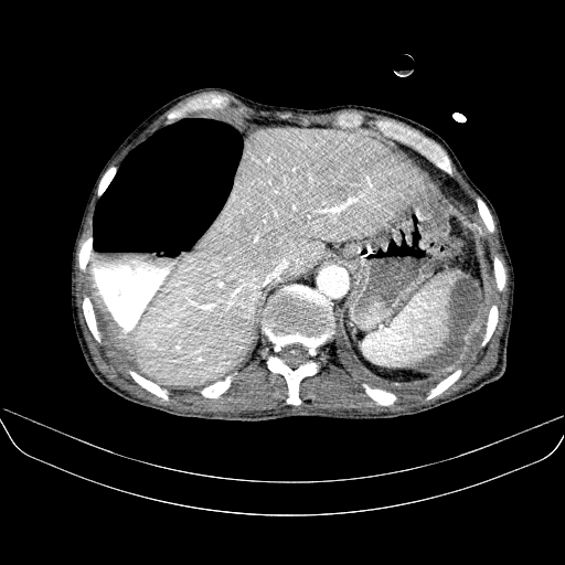 File:Abdominal collection due to previous cecal perforation (Radiopaedia 80831-94320 Axial C+ portal venous phase 35).jpg