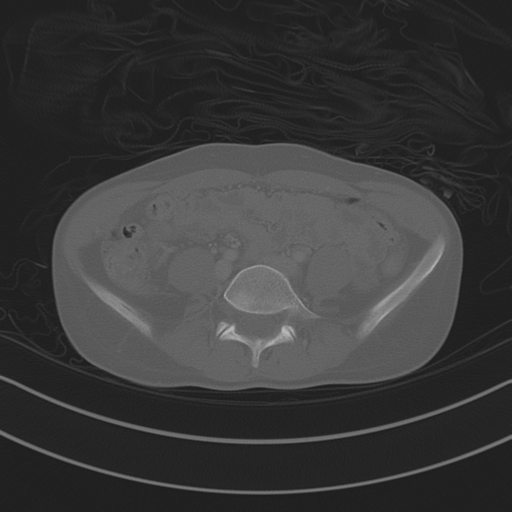 Abdominal multi-trauma - devascularised kidney and liver, spleen and pancreatic lacerations (Radiopaedia 34984-36486 Axial bone window 55).png